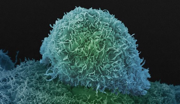 cell-prostate-cancer_0.jpg